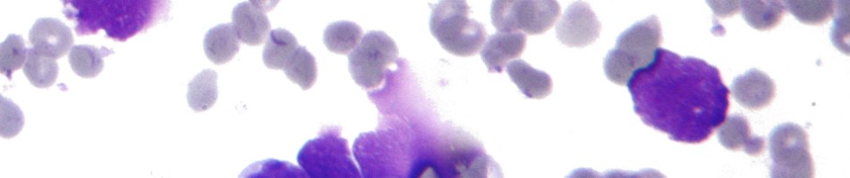 Breast Cancer Diagnosis Using R